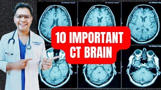 10 Important CT Brain radiology neuroradiology [upl. by Trill]