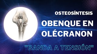 Osteosíntesis  Obenque en olécranon quotBanda a tensiónquot [upl. by Einiar]