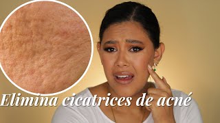 ELIMINAR CICATRICES POR ACNÉ o quotCACARIZOquot✨  MELI DE LA MORA [upl. by Pearle]