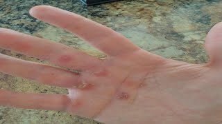 do calluses make your hands stronger [upl. by Aneem]