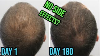 DUTASTERIDE MESOTHERAPY FOR HAIR LOSS TREATMENT NO SIDE EFFECTS [upl. by Latsryc]