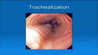 Eosinophilic Esophagitis Page [upl. by Powel264]