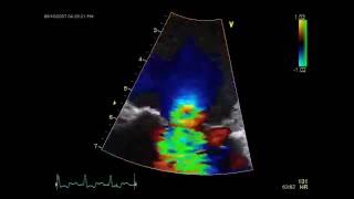 Cardiology Diagnostics Color Doppler Echocardiography [upl. by Durgy]