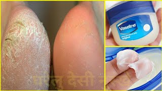 Vaseline सिर्फ 2 बार में फटी एड़ियों को कोमल बना देगा ये नुस्खा  Cracked Heels Treatment [upl. by Atipul862]