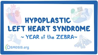 Hypoplastic left heart syndrome Year of the Zebra 2024 [upl. by Odelia]