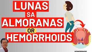 Lunas sa Almoranas or Hemorrhoids  By Doc Willie Ong [upl. by Anipsed]