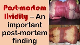 Postmortem lividity  An important postmortem change [upl. by Jemmie]