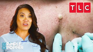 The BEST Blackhead Pops  Dr Pimple Popper  TLC [upl. by Scribner]