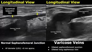 Saphenous Vein Doppler Ultrasound Normal Vs Abnormal  Varicose Veins  Lower Limb Vascular USG [upl. by Royce]