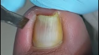 How to repair ingrown toenail [upl. by Salohci299]