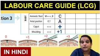 WHO Labour Care Guide in Hindi  LCG Guidelines  Nursing Lecture [upl. by Atthia]