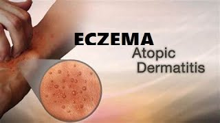 What is Eczema A Type of skin condition I Atopic Dermatitis I Allergic eczema I Neurodermatitis [upl. by Pearse]