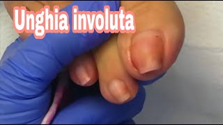 PEDICURE CURATIVO UNGHIA INCARNITA2°video trattato solo con fresa  armoniadonna [upl. by Arodnap476]