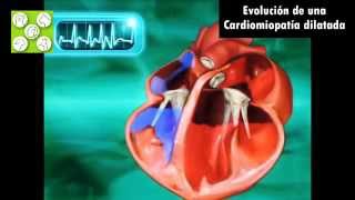 EL CORAZÓN PATOLÓGICO La Cardiomiopatía Dilatada CMD Aparición y evolución [upl. by Nomihs]