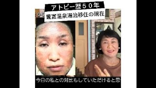 私のアトピー、豊富温泉湯治移住１６年の現在 [upl. by Adnaral]