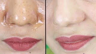 Easiest Way To Remove Blackheads amp Whiteheads In Some Minutes  Remove Blackheads From Your Nose [upl. by Eichman]