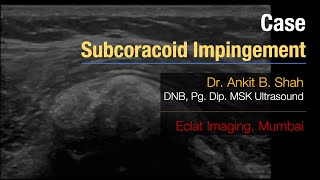 MSK Ultrasound  Subscapularis tendon calcification Subcoracoid Impingement [upl. by Ellerd231]