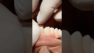 Class IV composite restoration dentist satisfying [upl. by Ayram]