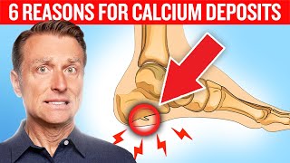 6 Reasons for Calcium Deposits Spurs Osteophytes Stones and Tartar [upl. by Felske]