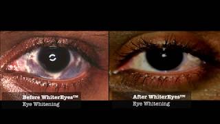 Nevus of Ota Eye Pigment Treatment with WhiterEyes® Eye Whitening Treatment [upl. by Clellan]