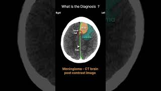 Meningioma CT brainpost contrast image Acute CT Brain Intracranial masses75radiologychannel007 [upl. by Odilo968]