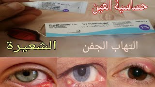 مرهم للعين 👍علاج التهاب العين والتعفنات والشعيرة👀 [upl. by Adnawt]