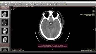 Diffuse axonal injury [upl. by Eicirtap374]