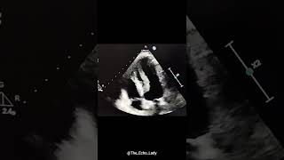 What would you do 😯 echocardiogram echocardiography cardiology [upl. by Anewor]