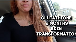 6 Months Of Glutathione  Whats Happening To My Skin [upl. by Neros]