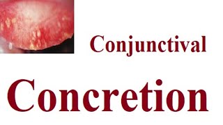 Conjunctival Concretions [upl. by Aiym]