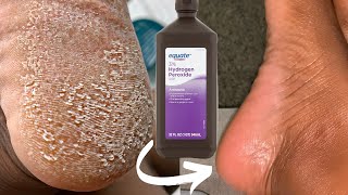 TRY HYDROGEN PEROXIDE ON YOUR FEET AND SEE WHAT HAPPENS Shocking [upl. by Anippesuig]