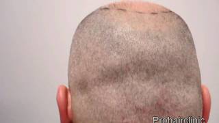 Donor area shaved after Mega FUE session hair transplant [upl. by Aerdnuahs]