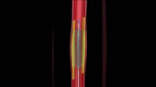 THE ULTIMATE ANGIOPLASTY ANIMATION  SEE HOW ITS DONE UP CLOSE [upl. by Ariajaj521]