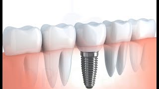 implant tedavisinin detaylı aşamaları 2 diş için [upl. by Neeron]