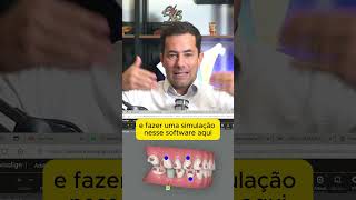 Antes e depois com Invisalign mordida aberta [upl. by Beeson]