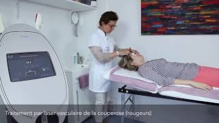 Lumière intense pulsée IPL pour le traitement des rougeurs et varicosités [upl. by Oramug]