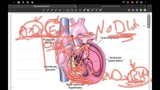 Ch 6 Cardiology Cyanotic heart diseases [upl. by Penney]