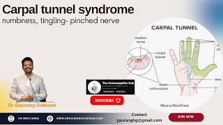 Homoeopathic Strategies in Carpal Tunnel Dr Gaurang Gaikwad [upl. by Ettenig]