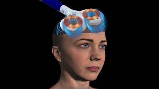 What is rTMS Repetitive Transcranial Magnetic Stimulation [upl. by Alesram]