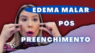 Edema malar pós preenchimento facial Causas e consequências [upl. by Anieral]