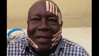 NeuroMuscular Taping treatment of Bells Palsy Congo [upl. by Ludlew]