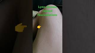 muscle fasciculations form Lyme lymeawareness [upl. by Nahshunn]