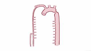 Coarctation of the Aorta CoA repair causes symptoms amp pathology [upl. by Aviv]