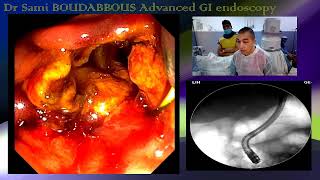 ERCP FOR ACUTE CHOLANGITIS [upl. by Maghutte622]