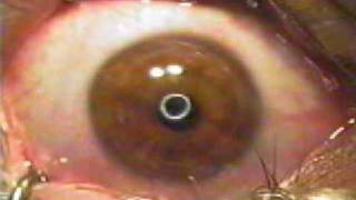 Nystagmus Eyes Under A Lasik Machine [upl. by Ausoj384]