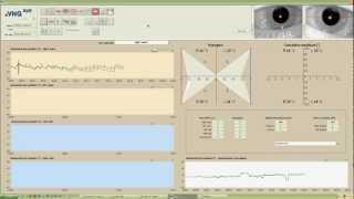 eVNG Caloric Test Demo [upl. by Vaas]