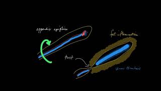 Epiploic appendagitis what the heck is that [upl. by Rennold871]