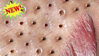 Amazing Blackheads Remover on the Face 010 [upl. by Quirita831]