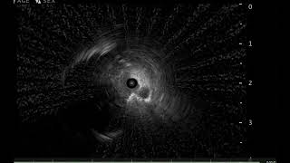 Cone beam CT guided Biopsy [upl. by Jadda659]