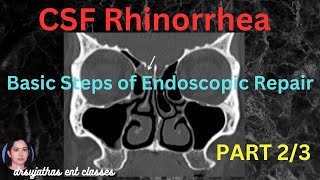 235CSF Rhinorrhea Part 23 CSF Rhinorrhea Treatment surgeryeducation dentallectures [upl. by Fleck555]